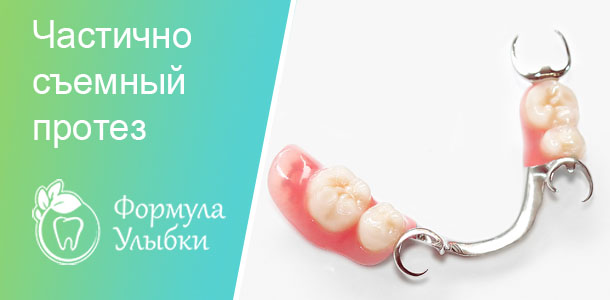 Частично съемный протез в Казани. Опытные врачи клиники «Формула Улыбки» качественно оказывают стоматологические услуги по оптимальной цене