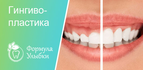 Гингивопластика в Казани. Опытные врачи клиники «Формула Улыбки» качественно оказывают стоматологические услуги по оптимальной цене