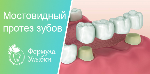 Мостовидный протез в Казани. Опытные врачи клиники «Формула Улыбки» качественно оказывают стоматологические услуги по оптимальной цене