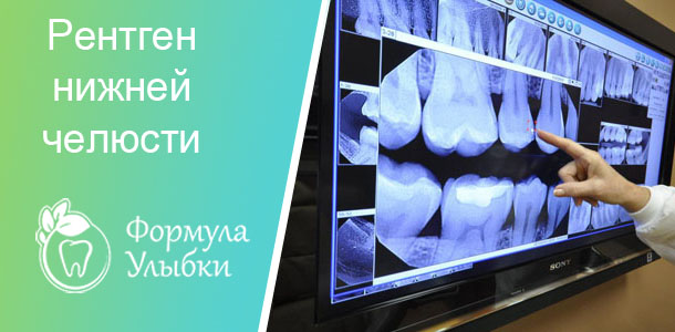 Рентген нижней челюсти в Казани. Опытные врачи клиники «Формула Улыбки» качественно оказывают стоматологические услуги по оптимальной цене