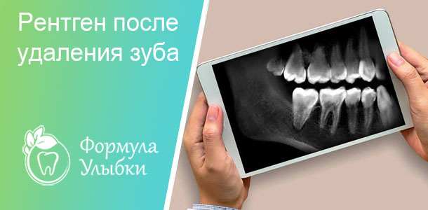 Рентген после удаления зуба в Казани. Опытные врачи клиники «Формула Улыбки» качественно оказывают стоматологические услуги по оптимальной цене