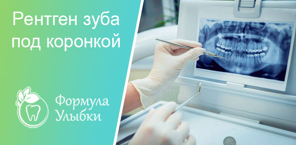 Рентген зуба под коронкой в Казани. Опытные врачи клиники «Формула Улыбки» качественно оказывают стоматологические услуги по оптимальной цене