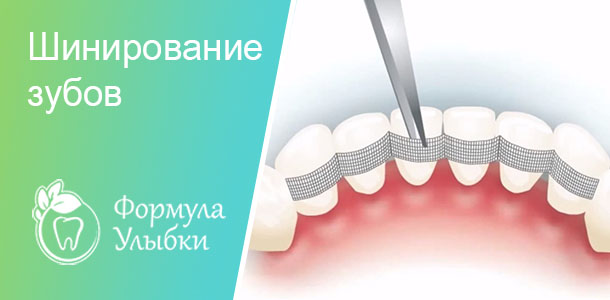 Шинирование зубов в Казани. Опытные врачи клиники «Формула Улыбки» качественно оказывают стоматологические услуги по оптимальной цене