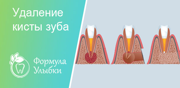Удаление кисты зуба в Казани. Опытные врачи клиники «Формула Улыбки» качественно оказывают стоматологические услуги по оптимальной цене