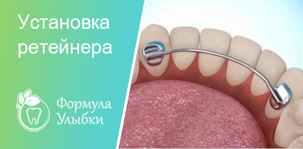 Установка ретейнеров в Казани. Опытные врачи клиники «Формула Улыбки» качественно оказывают стоматологические услуги по оптимальной цене