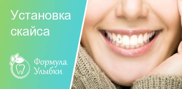 Установка скайса в Казани. Опытные врачи клиники «Формула Улыбки» качественно оказывают стоматологические услуги по оптимальной цене