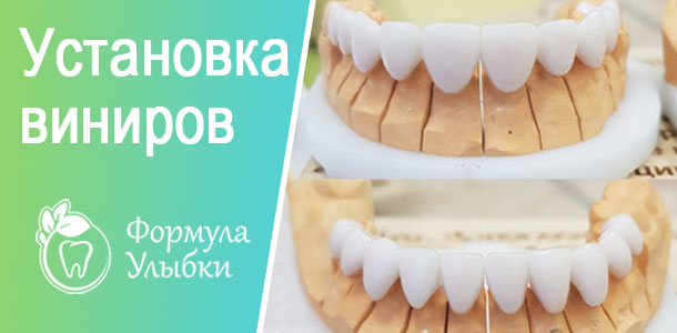 Установка виниров в Казани. Опытные врачи клиники «Формула Улыбки» качественно оказывают стоматологические услуги по оптимальной цене